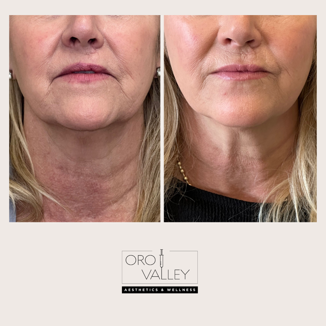 Before and after tox treatment result 2