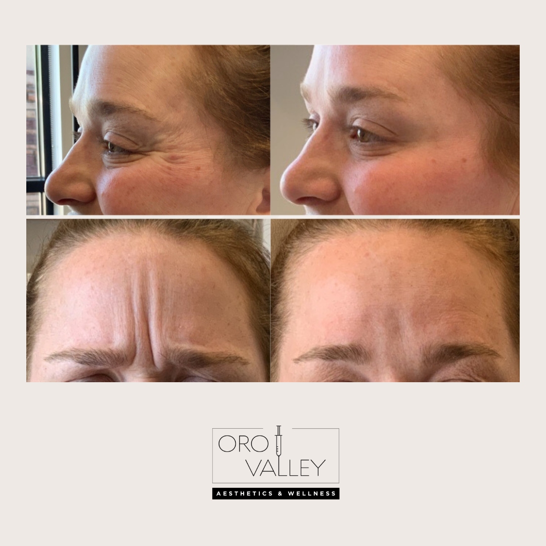 Before and after tox treatment result 1